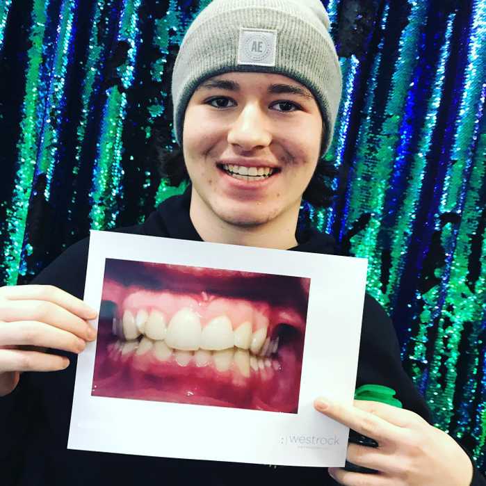 A patient named Aiden showing off his new smile next to a picture of his smile before